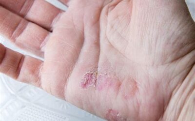 ¿Que es la Psoriasis Palmoplantar?